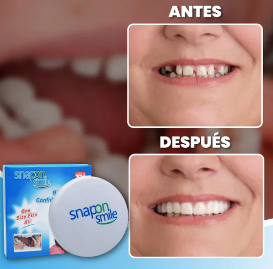 Carillas Snap On Smile dientes 🦷
